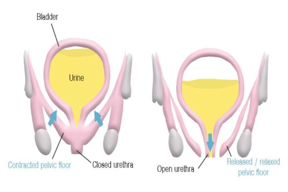 How can sport lead to pelvic floor dysfunction?- Fizimed